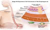 Trial Establishes Preferred Treatment for Some People with Esophageal Cancer
