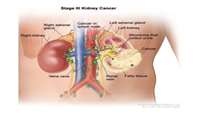 Pembrolizumab Provides First-Ever Overall Survival Improvement in Kidney Cancer